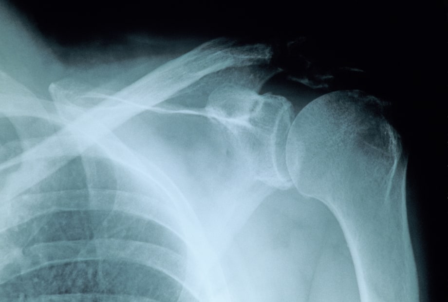 A Crash Course In Shoulder Anatomy