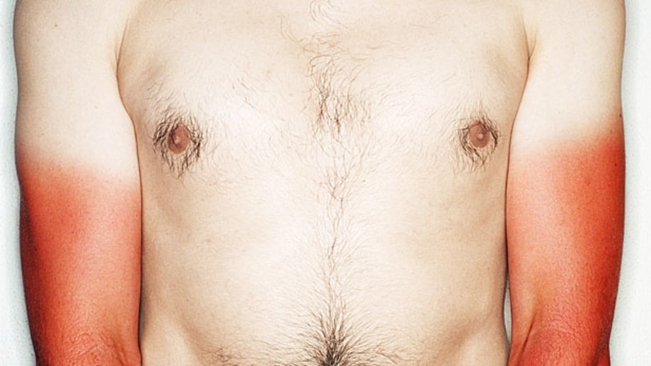 10 Tips for Treating a Nasty Sunburn