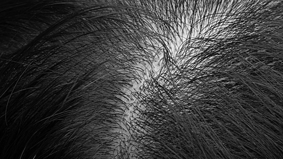 Baldness Comes From Your Mother's Side: Myth
