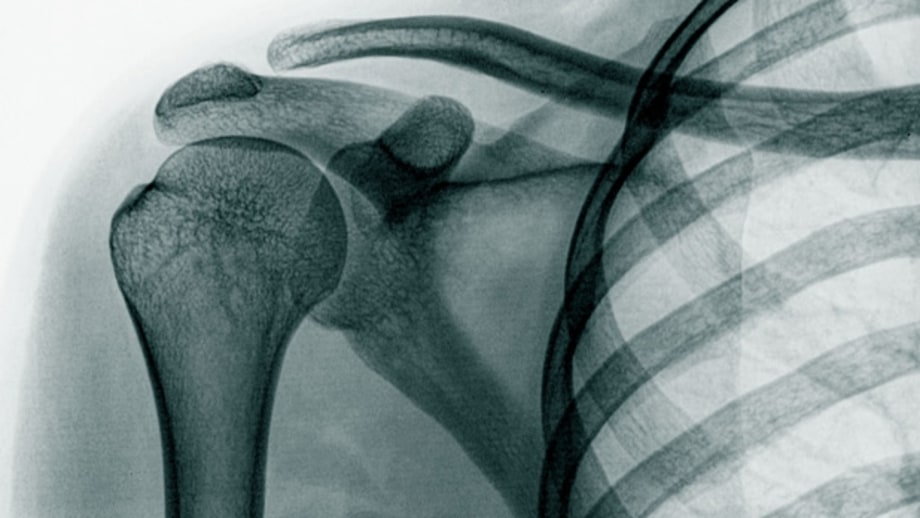 Six Ways to Build Stronger Bones