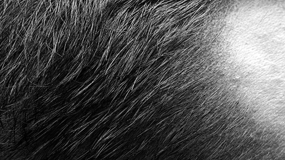 Hair Restoration Never Looks Natural: Myth