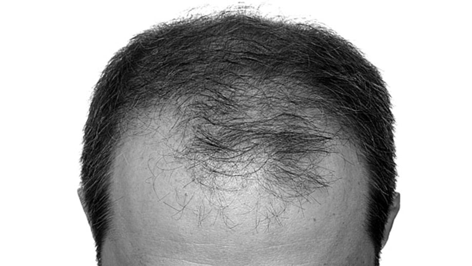 Mistreating Your Hair Can Cause Hair Loss: Fact