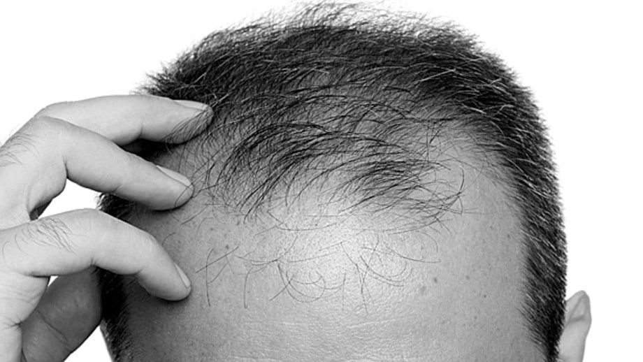 10 Myths and Facts about Hair Loss