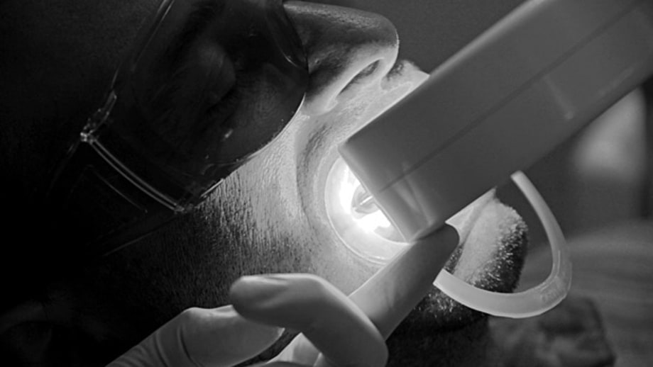 Professional bleaching procedures