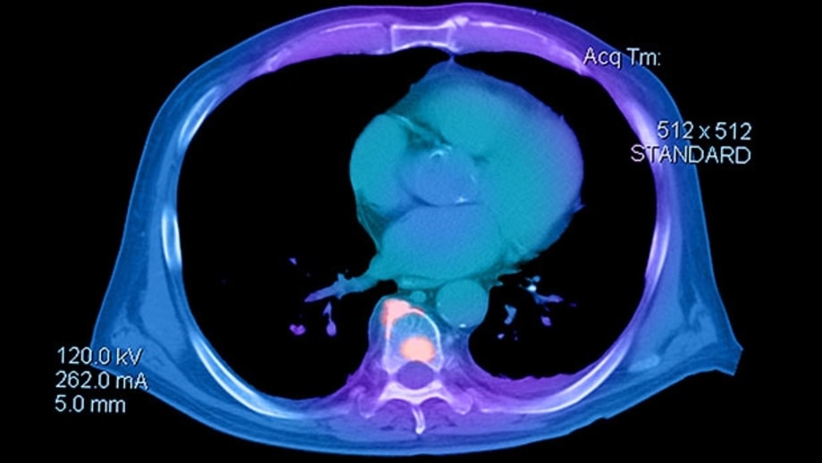 Prostate Cancer