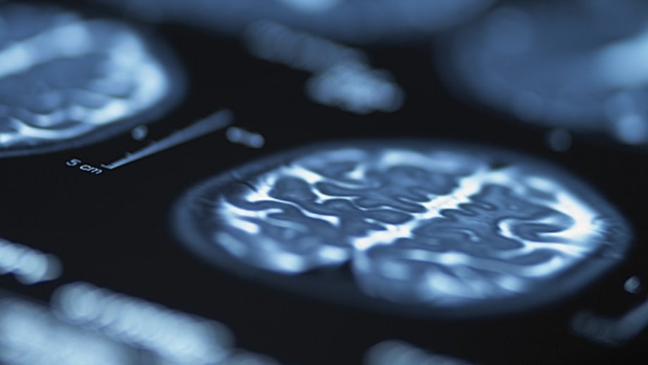 MRIs and CT scans for Headaches