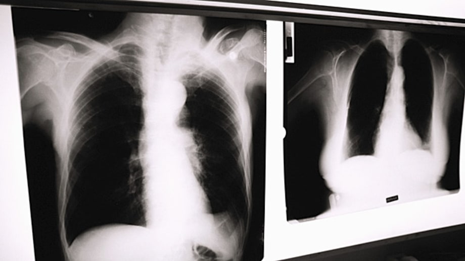 Routine Chest X-Rays Before Outpatient Hospital Procedures
