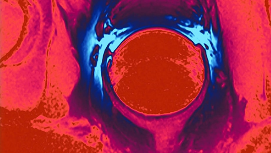 Six Tips for Prostate Health