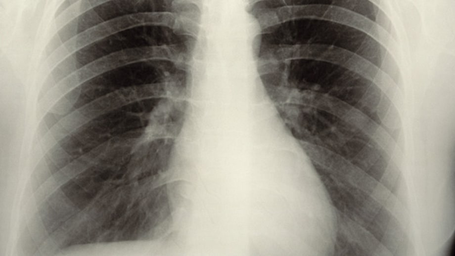 Heart stress tests or chest X-rays before minor surgery