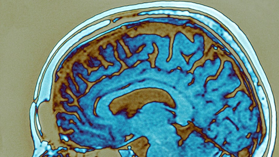 MRIs or CT scans for concussions or headaches without serious symptoms