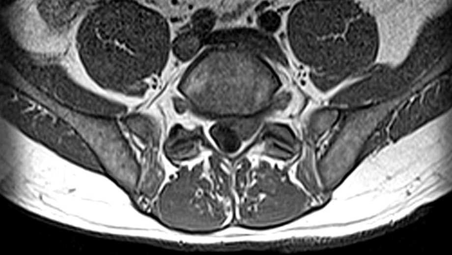 MRIs or CT scans for low back pain