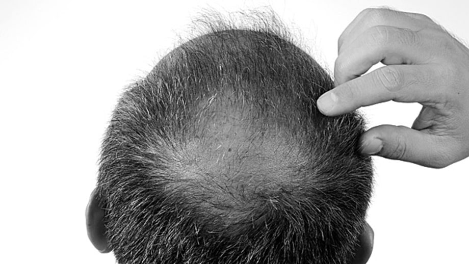 You Can Prevent Hair Loss: Myth