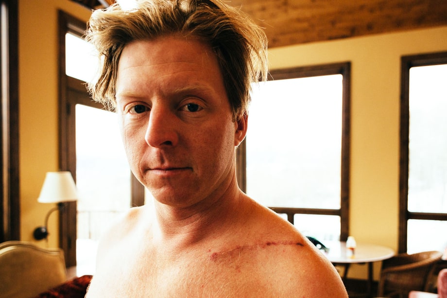 Scar Tissue