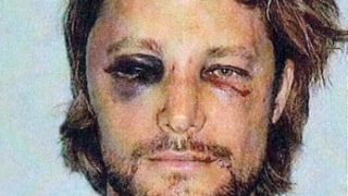 See Gabriel Aubry's Black Eye, Bloody Face After Olivier Martinez Fight