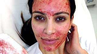 Kim Kardashian, vampire facials