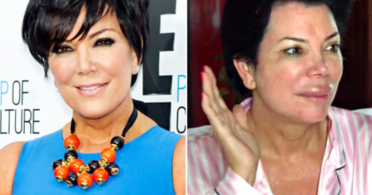 See Kris Jenner's Swollen, Puffy Lips! Us Weekly
